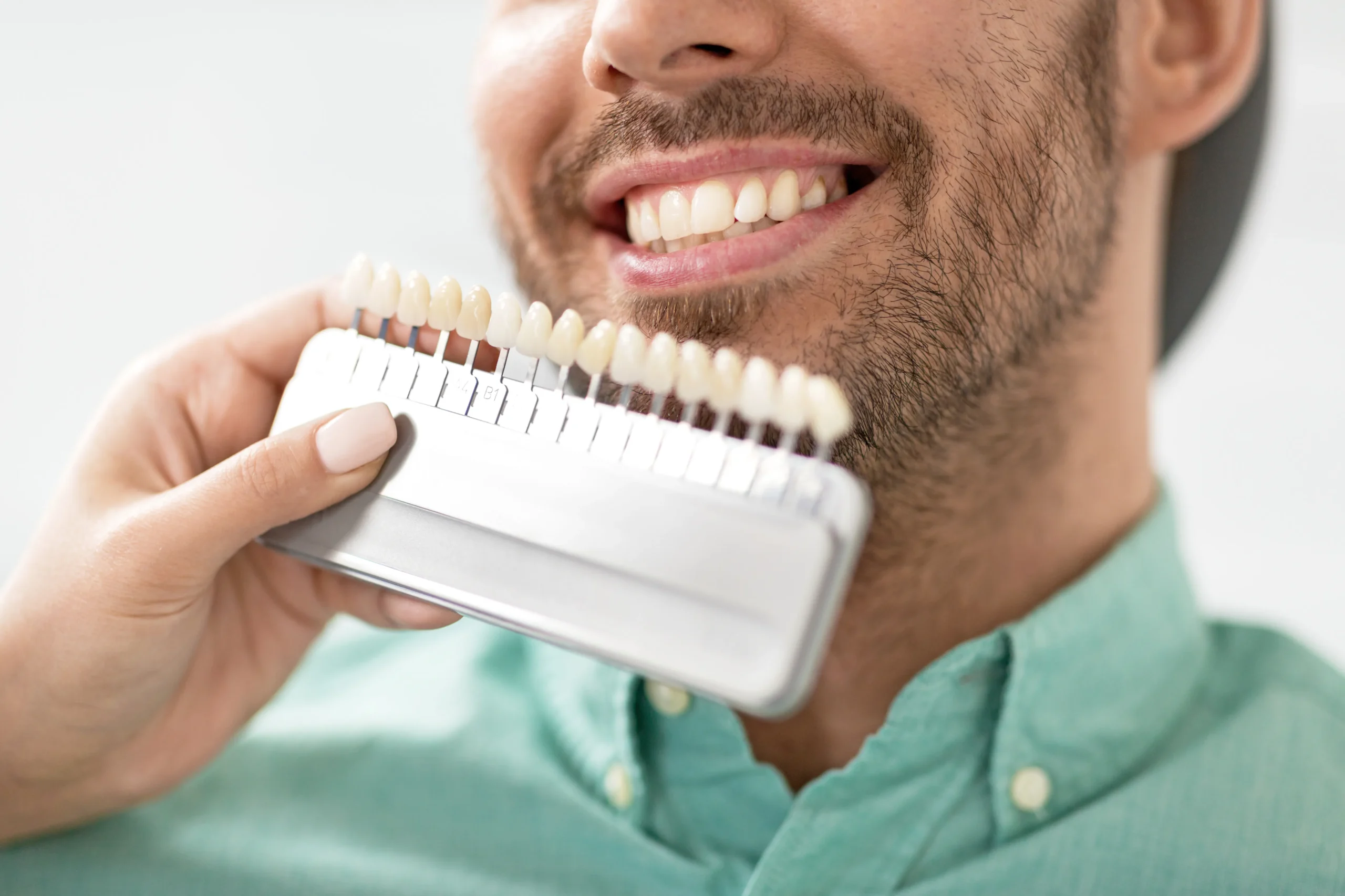 Farbabstimmung für Veneers mit Zahnschablone – ästhetische Zahnkorrektur durch hauchdünne Keramikverblendschalen in der Zahnarztpraxis.