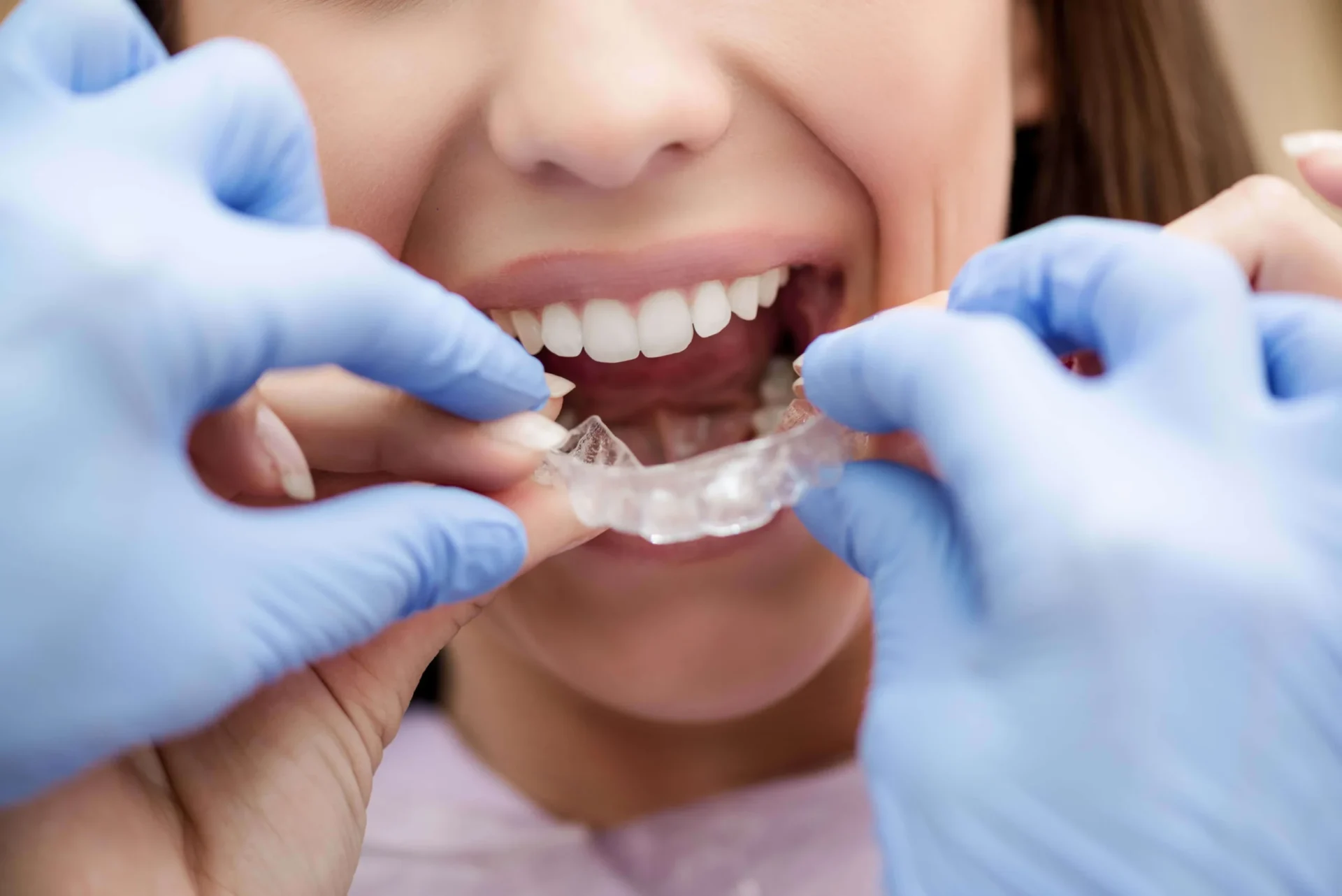 Nahaufnahme einer Frau beim Einsetzen einer transparenten Aligner-Schiene durch eine zahnmedizinische Fachkraft mit blauen Handschuhen.