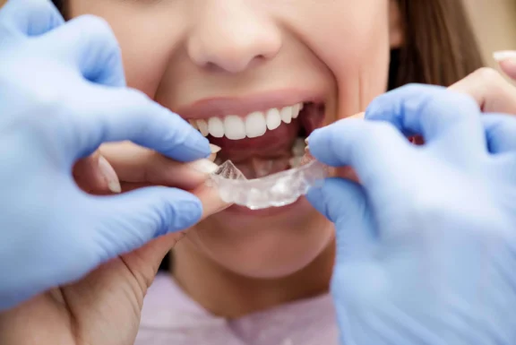 Nahaufnahme einer Frau beim Einsetzen einer transparenten Aligner-Schiene durch eine zahnmedizinische Fachkraft mit blauen Handschuhen.