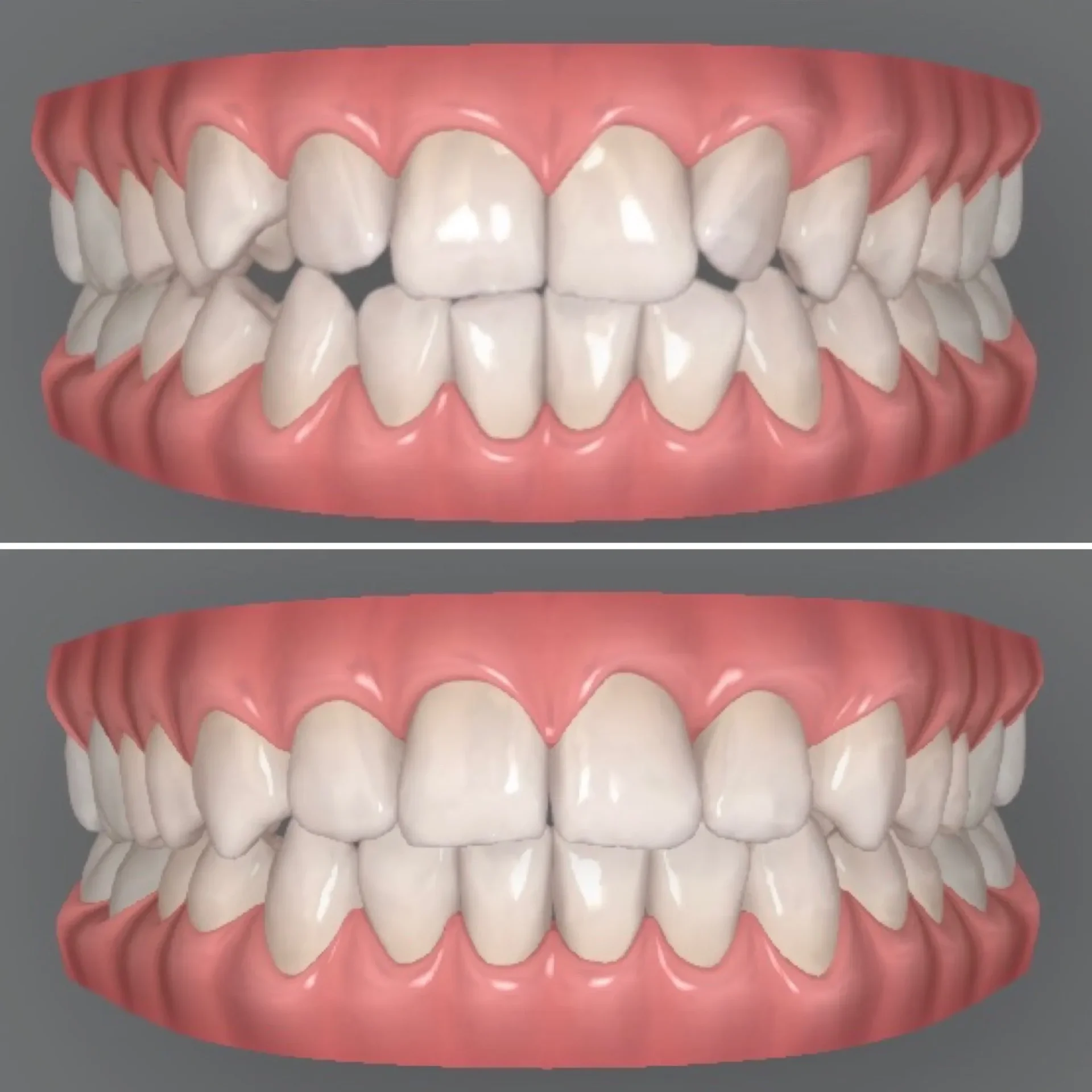 3D-Vergleichsansicht eines menschlichen Gebisses vor (oben) und nach (unten) der kieferorthopädischen Behandlung mit Invisalign.
