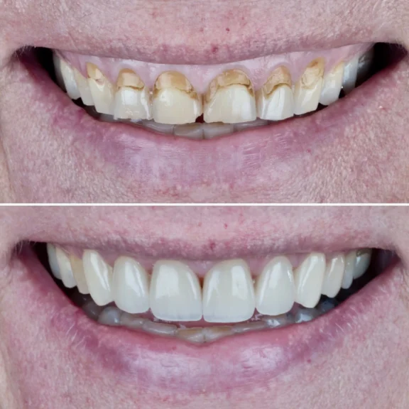 Vorher-Nachher-Bild eines Lächelns – stark verfärbte, beschädigte Zähne vor der Behandlung, darunter ästhetisch sanierte Zähne mit hochwertigen Veneers.