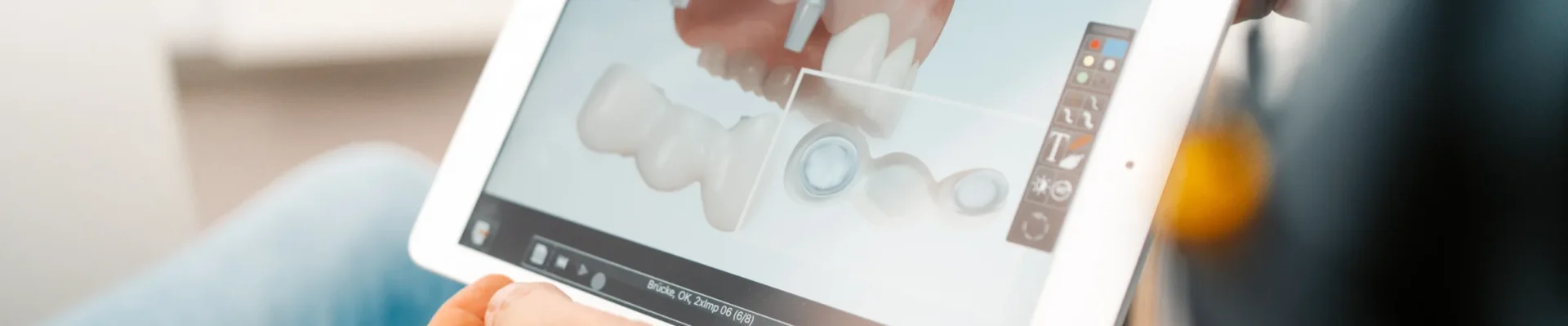 Zahnarzt zeigt einem Patienten am Tablet die digitale 3D-Planung einer Zahnversorgung mit Brücke und Implantat.