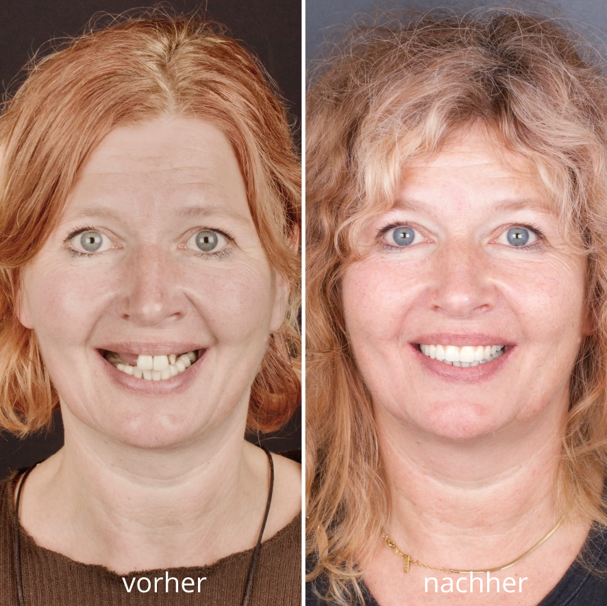 Vorher-Nachher-Bild einer Patientin mit deutlicher Veränderung: Zahnlücken vor der Behandlung, harmonisches Lächeln mit vollständigem Zahnersatz danach.