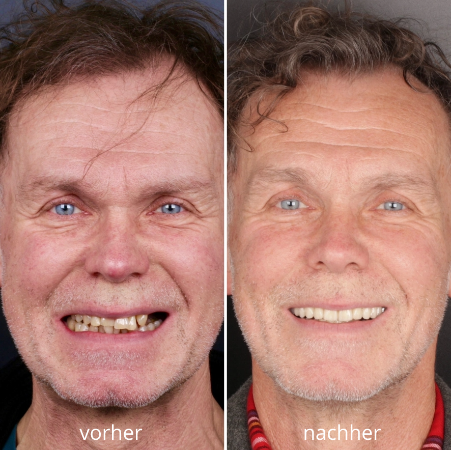 Vorher-Nachher-Bild eines Patienten mit sichtbarer Veränderung: zahnlose, beschädigte Zähne vor der Behandlung, fester Zahnersatz und natürliches Lächeln danach.
